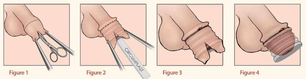 Overview of the Circumcision Procedure